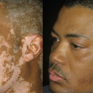 vitiligo sur visage d'homme
