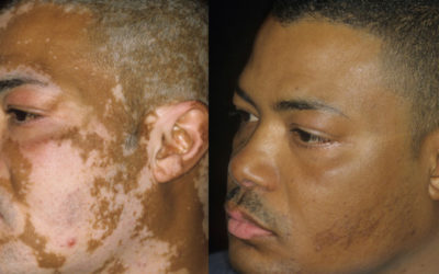 Camouflage tâches vitiligo – Disponible printemps 2024
