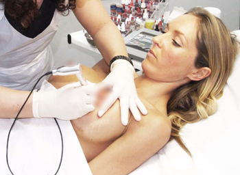 Formation pigmentation téton Pigmentation des seins