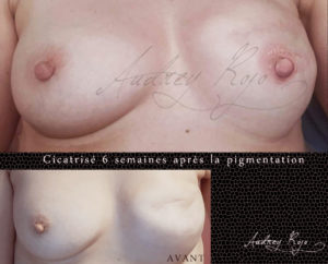 Aréole mammaire tatouée Aréole mammaire tatouée