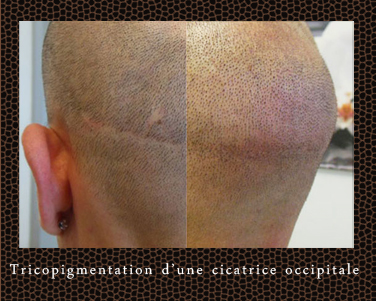 Tatouage de cheveux sur cicatrice Tatouage du cuir chevelu