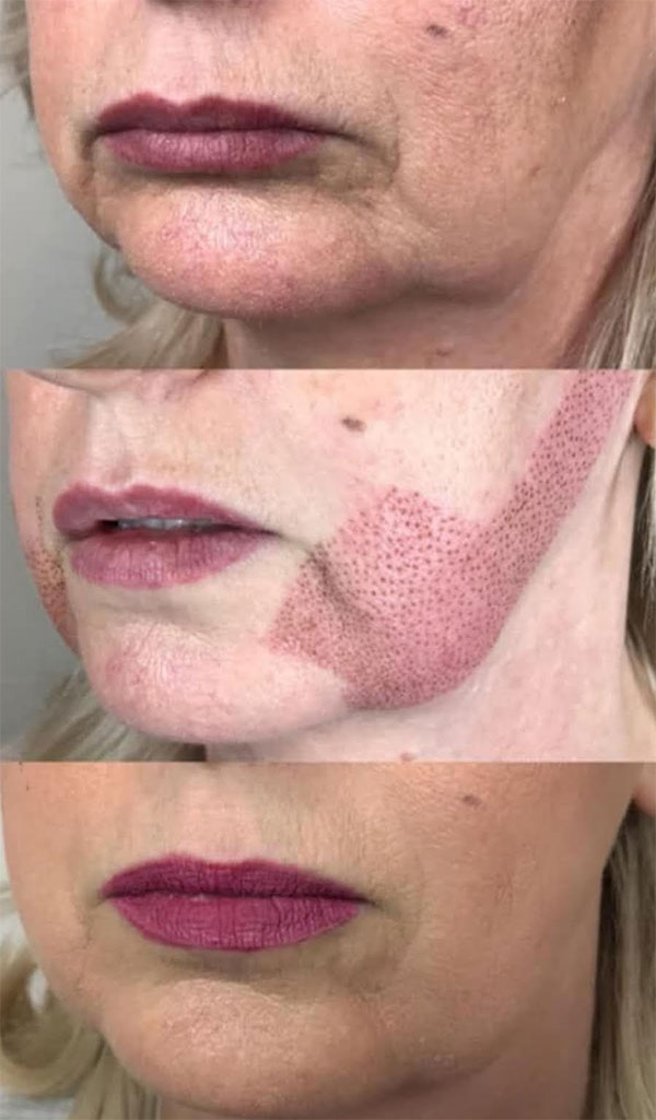 Le plasma pen pour ovale du visage