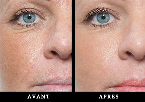 Dermaplaning dans le Tarn