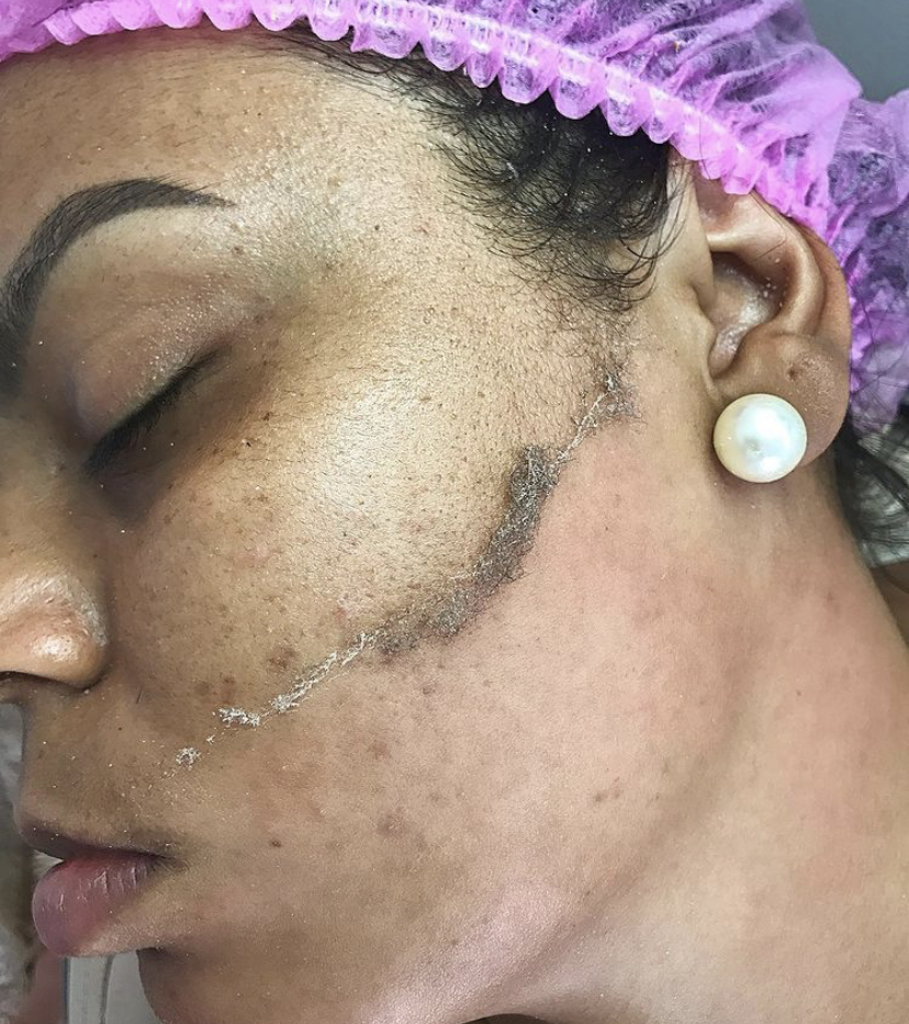 Dermaplaning-peaunoire1-EléaGiorgini