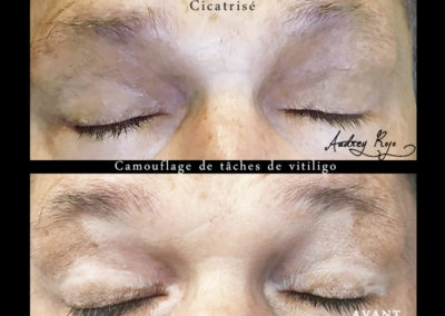 Camouflage de tâches de vitiligo