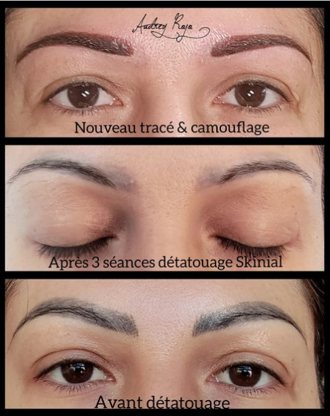 Sourcils ratés : détatouage