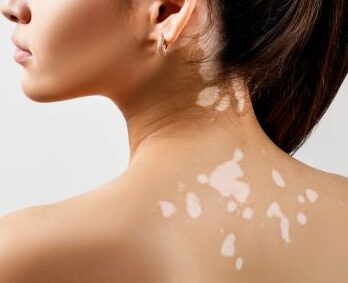 vitiligo peinture