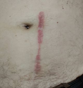 Cicatrice sur le ventre