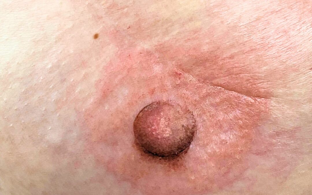 Éviter le blocage de photos d’aréoles ou téton sur Instagram
