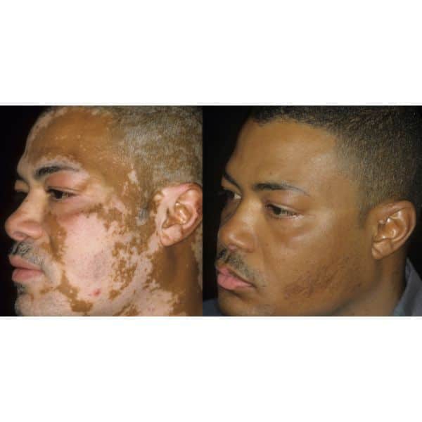 vitiligo