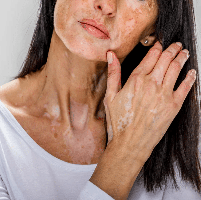 vitiligo
