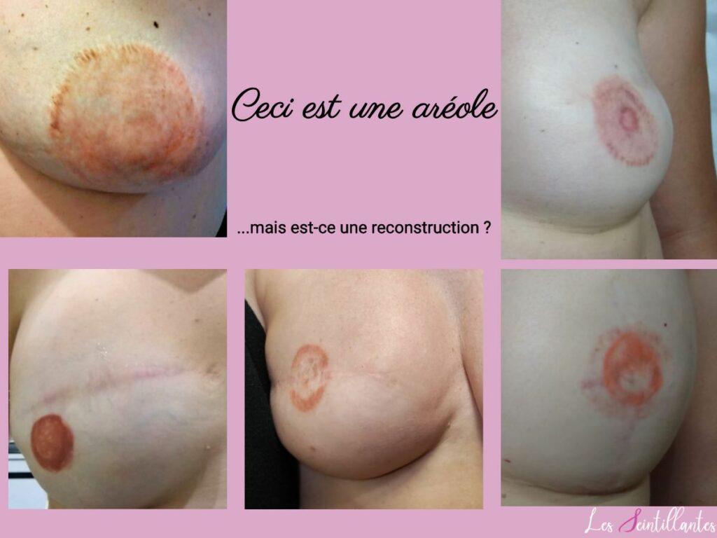 Téton après cancer du sein
