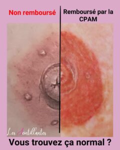 Tatouage du sein remboursé par la securite sociale Comparaison tatouage non remboursé fait par une spécialiste, et celui remboursé fait à l'hopital.