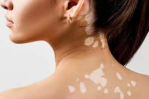 vitiligo peinture