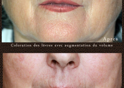 maquillage permanent des lèvres